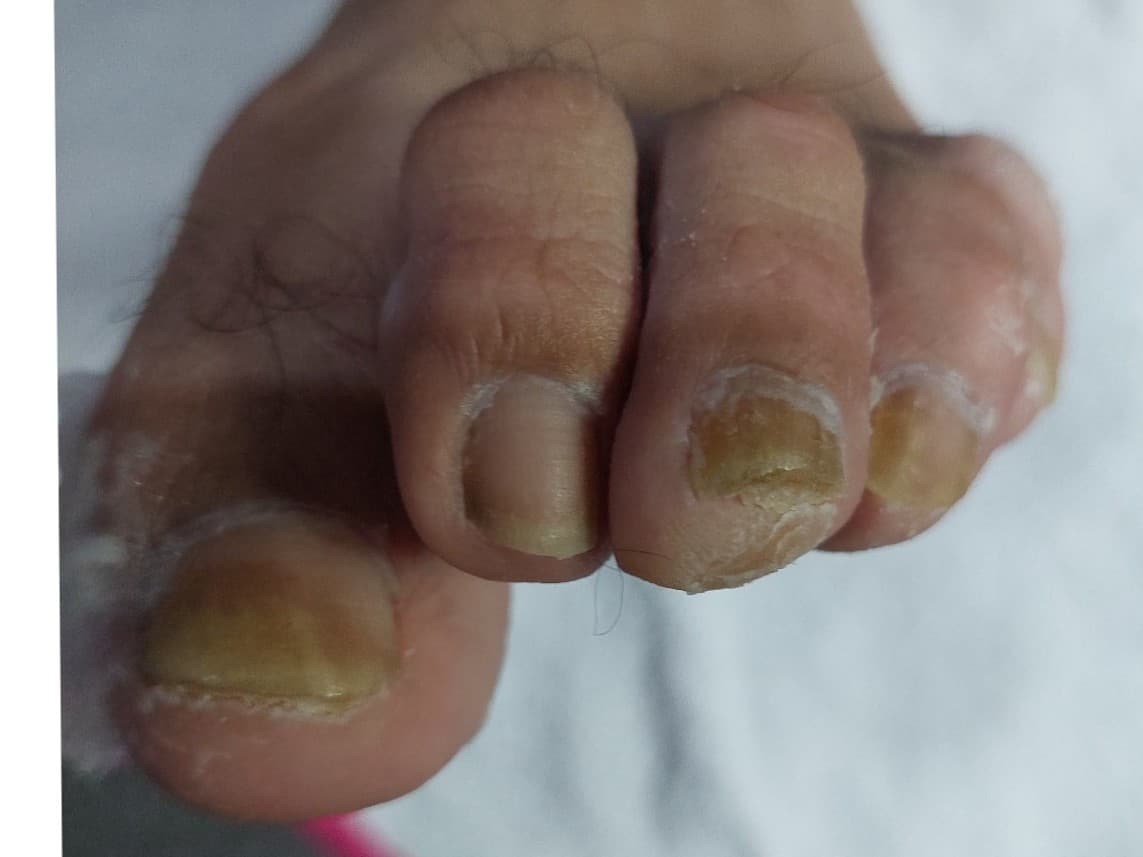 Pedicuria